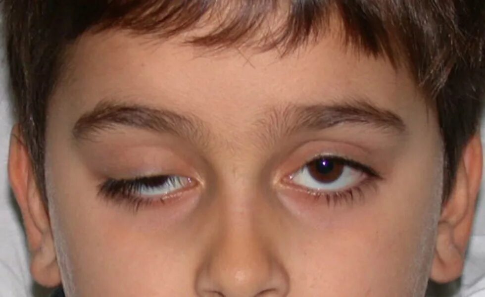 1 глаз не закрывается. Бернара-горнера (птоз, миоз, энофтальм).. Синдром птоз верхнего века.