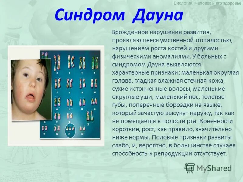 План дауна. Синдром Дауна. Болезнь Дауна описание. Синдром Дауна презентация.