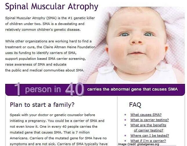 Тест с ответами проксимальная спинальная мышечная атрофия. Spinal muscular atrophy. спинальная мышечная атрофия гены. sma symptoms. спинально мышечная атрофия генетика.