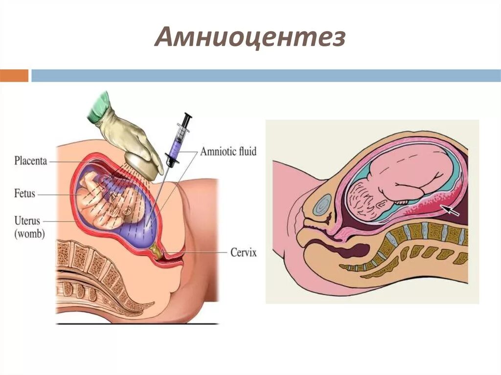 Исследование околоплодных вод амниоцентез. Трансцервикальный амниоцентез. Пренатальная диагностика амниоцентез. Амниоцентез это исследование.