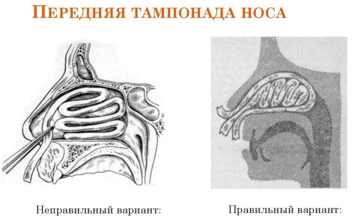 Задняя тампонада носа показания. Передняя и задняя тампонада носа алгоритм. Задняя тампонада полости носа. Задняя тампонада носа при носовом кровотечении.