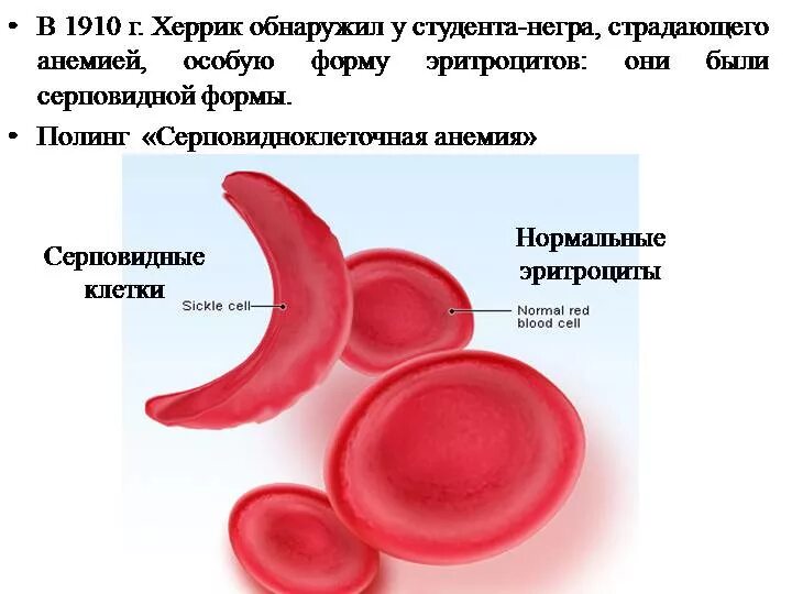 Форма эритроцитов человека. Серповидно-клеточная анемия. Серповидноклеточная анемия эритроциты. Гемоглобинопатии серповидноклеточная анемия. Серповидно клетчатая анемия.