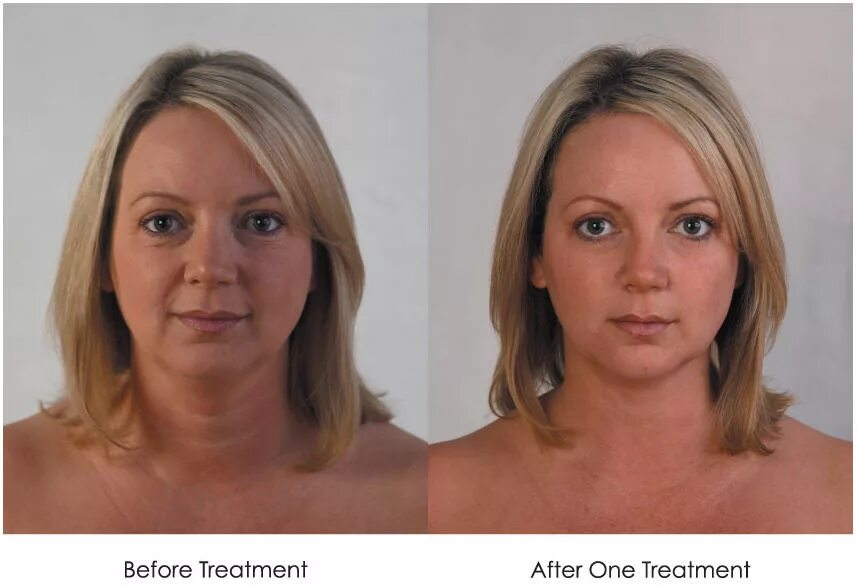 Лпджи массаж лица до и после. Моделирующий массаж лица до и после. Lpg лица до и после. Lpg лица до и после. Lpg массаж лица эффект до и после.