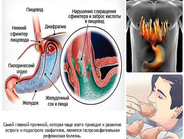 К чему приводит рефлюкс. Гастроэзофагеальная рефлюкс болезнь. гастроэзофагеальный рефлюкс этиология.