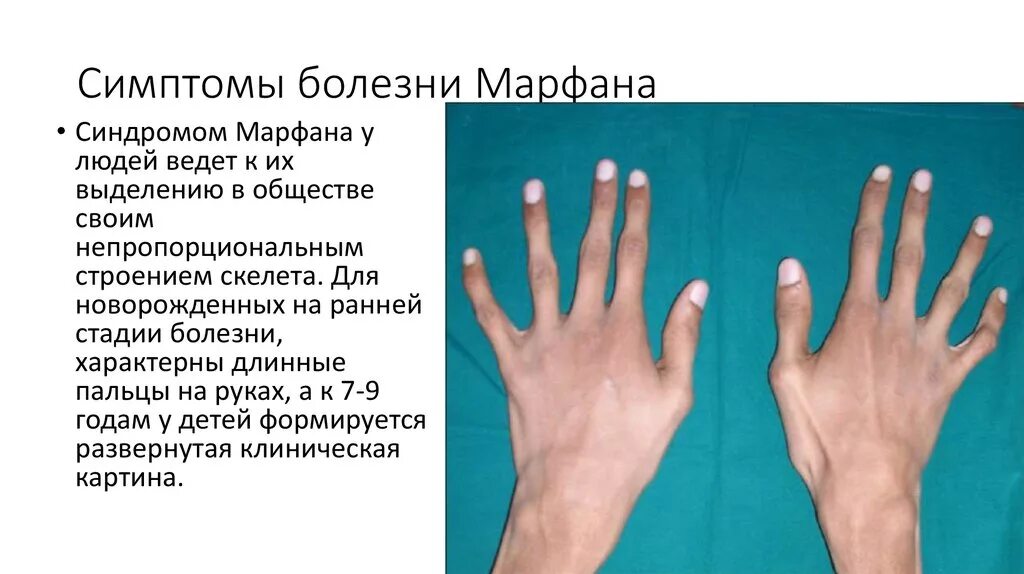 Синдром длинных пальцев. Наследственные заболевания синдром марфана. дст дисплазия соединительной ткани. соединительнотканная дисплазия (синдром марфана).