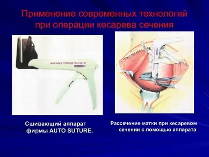 Сечение матки