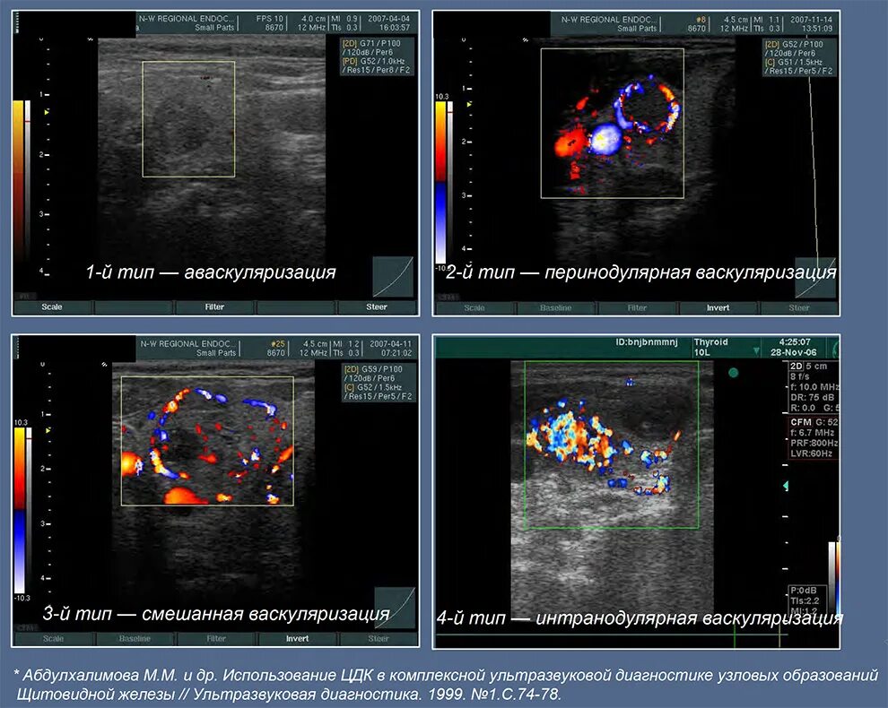 Васкуляризация усилена. Васкуляризация щитовидной железы. Васкуляризация щитовидной железы усилена. Ультразвуковая диагностика. Усиление васкуляризации щитовидной железы что это такое.