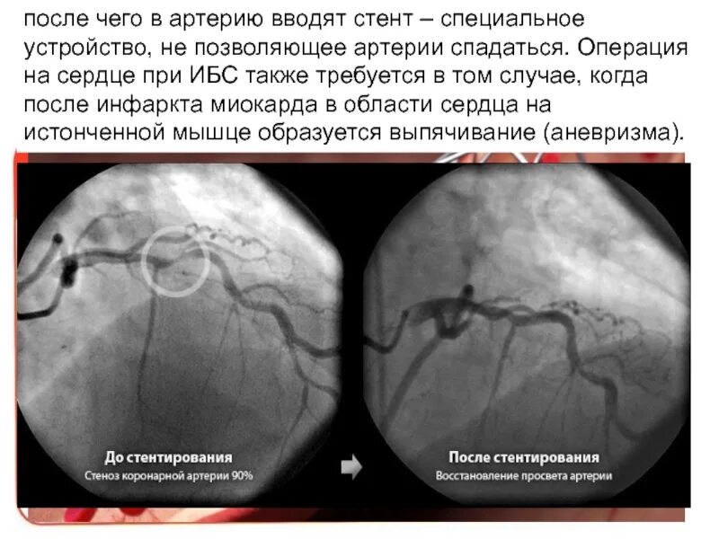Стенд после инфаркта
