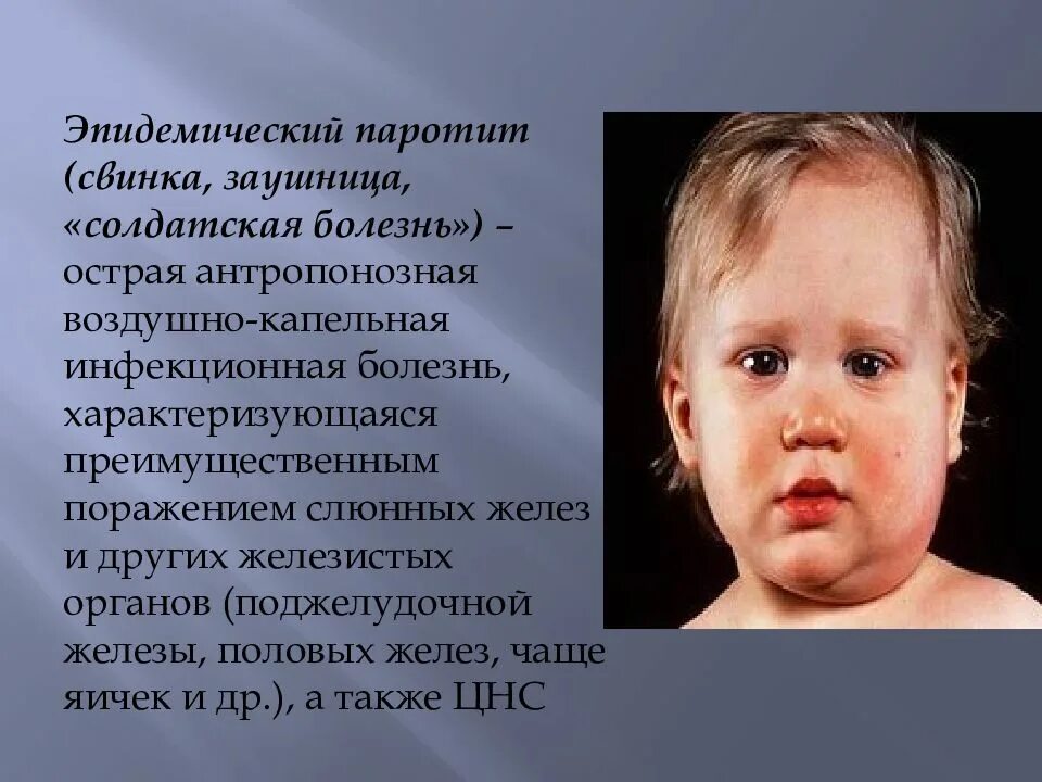 Какие признаки свинки. Свинка эпидемический паротит. Эпидемический паротит у детей. Эпидемический паротит Свинка болезнь. Эпидемический паротит Свинка заушница.