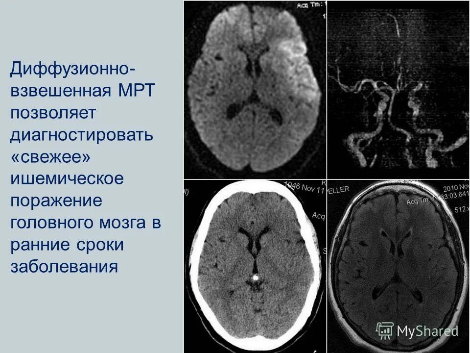 Диффузные органические поражения головного мозга. Диффузионно-взвешенная мрт. поражение головного мозга. диффузионная мрт мозга. ишемическое поражение головного мозга.