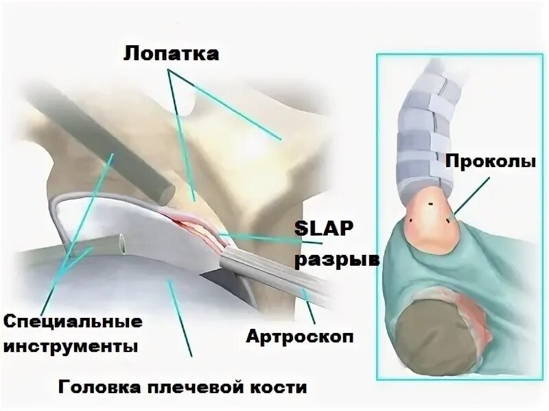 Повреждение суставной губы плечевого сустава slap. Slap синдром плечевого сустава операция.