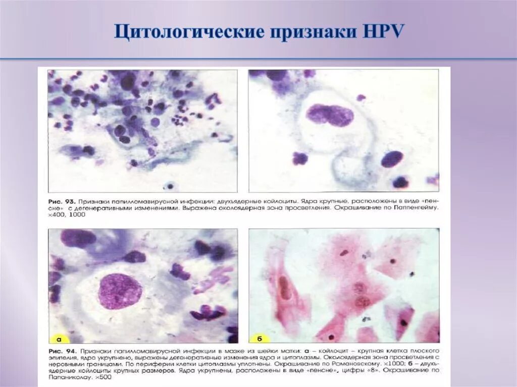 Воспаление с реактивными изменениями клеток. Цилиндрический эпителий шейки матки цитология. Дисплазия шейки матки цитология. Дисплазия клеток плоского эпителия.