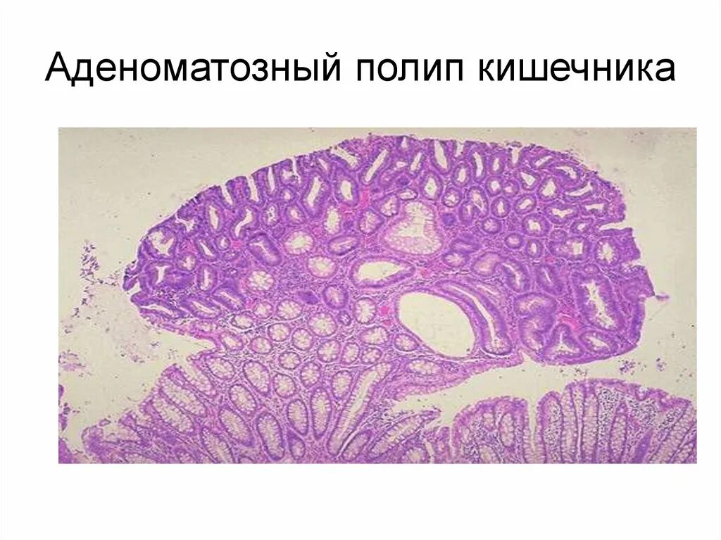 Микровезикулярный полип толстой кишки. Аденоматозный полип толстой кишки гистология. Гиперпластический полип кишки гистология. Полип толстой кишки микропрепарат. Пролиферирующий аденоматозный полип толстой кишки микропрепарат.