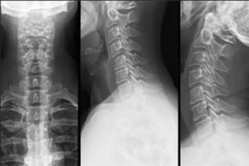 Рентген шейного отдела с функциональными пробами