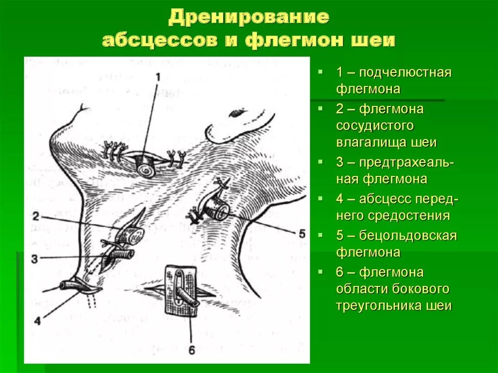 Дренаж при абсцессе