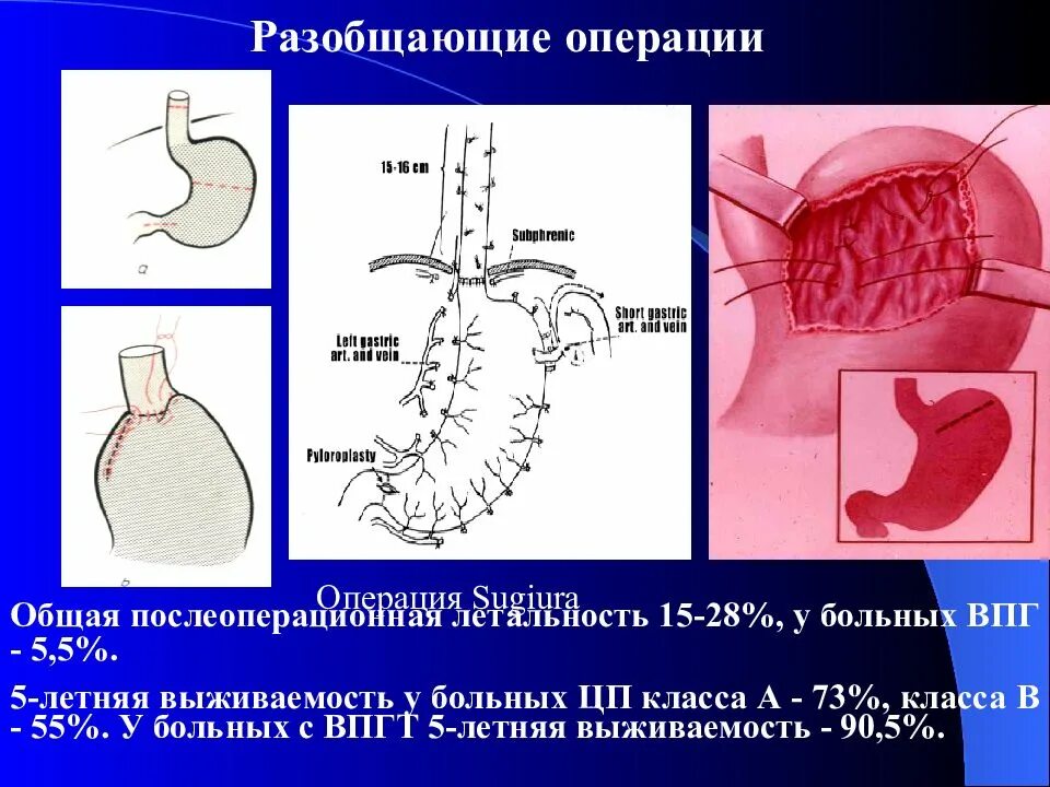 Операция гипертония. Операция Таннера Пациоры. Операция Сугиура при портальной гипертензии.