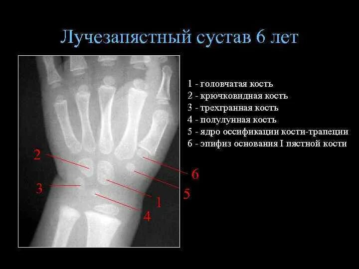 Первый запястно пястный сустав. Гороховидная кость запястья рентген. перелом крючковидной кости. перелом крючковидной кости запястья. зоны роста лучезапястного сустава.