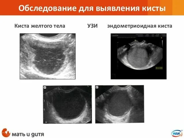 Как отличить кисту. Эндометриоидная киста яичника. Фолликулярная киста желтого тела яичника на УЗИ. Фолликулярная киста и эндометриоидная киста. Киста желтого тела яичника и эндометриоидная киста на УЗИ.