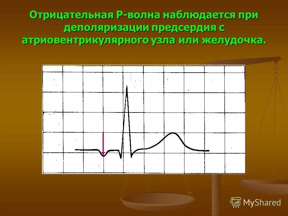 Отрицательный зубец p. Внешние эффекты в потреблении. Показатель r целое отрицательное нечетное число. П отрицательно. П отрицательно.