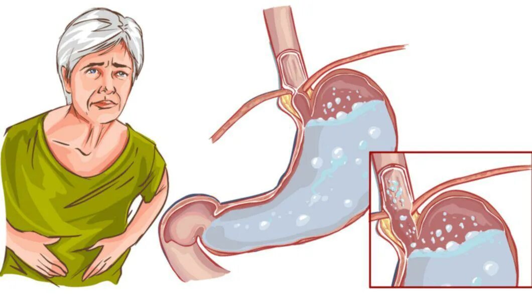 Как снять спазм желудка. Резких приступов гастрита.