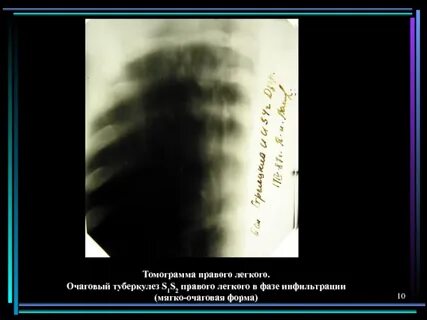 Очаговый легких в фазе инфильтрации