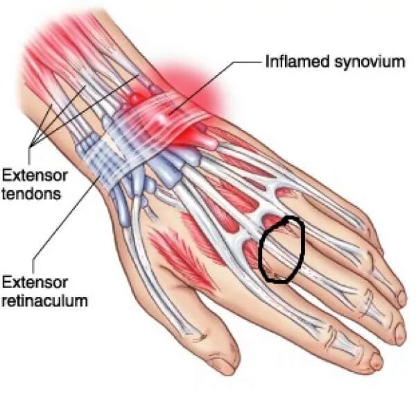 Связки на руке. Тендовагинит лучезапястного. Воспаление сухожилий лучезапястного сустава. Тендовагинит лучезапястного сустава. Тендовагинит разгибателей пальцев кисти.