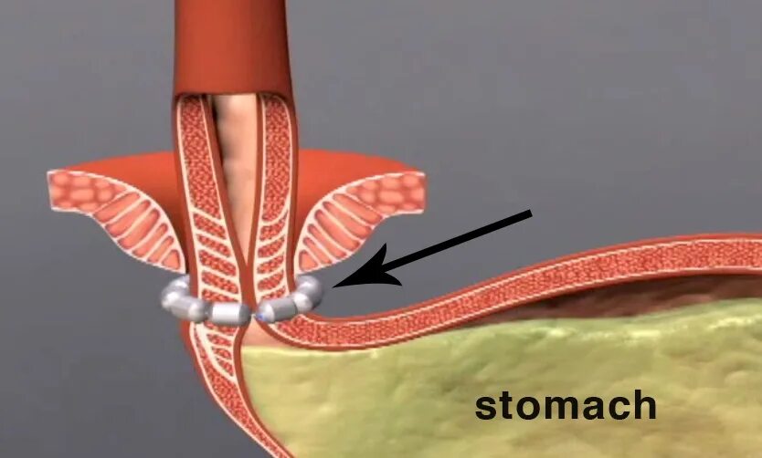 Мышечное кольцо сфинктера. Магнитный браслет на пищевод. Почему сфинктер