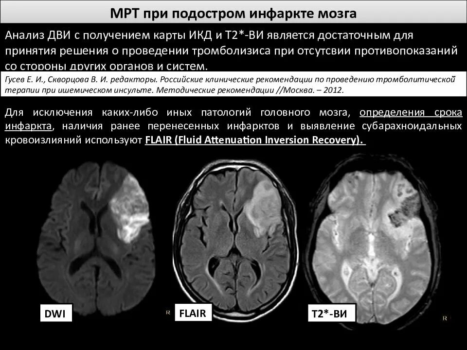 Стадии ишемии головного. Ишемический инсульт мрт Dwi. Ишемический инсульт кт и мрт. ОНМК по ишемическому типу кт. Ишемический ОНМК на кт.