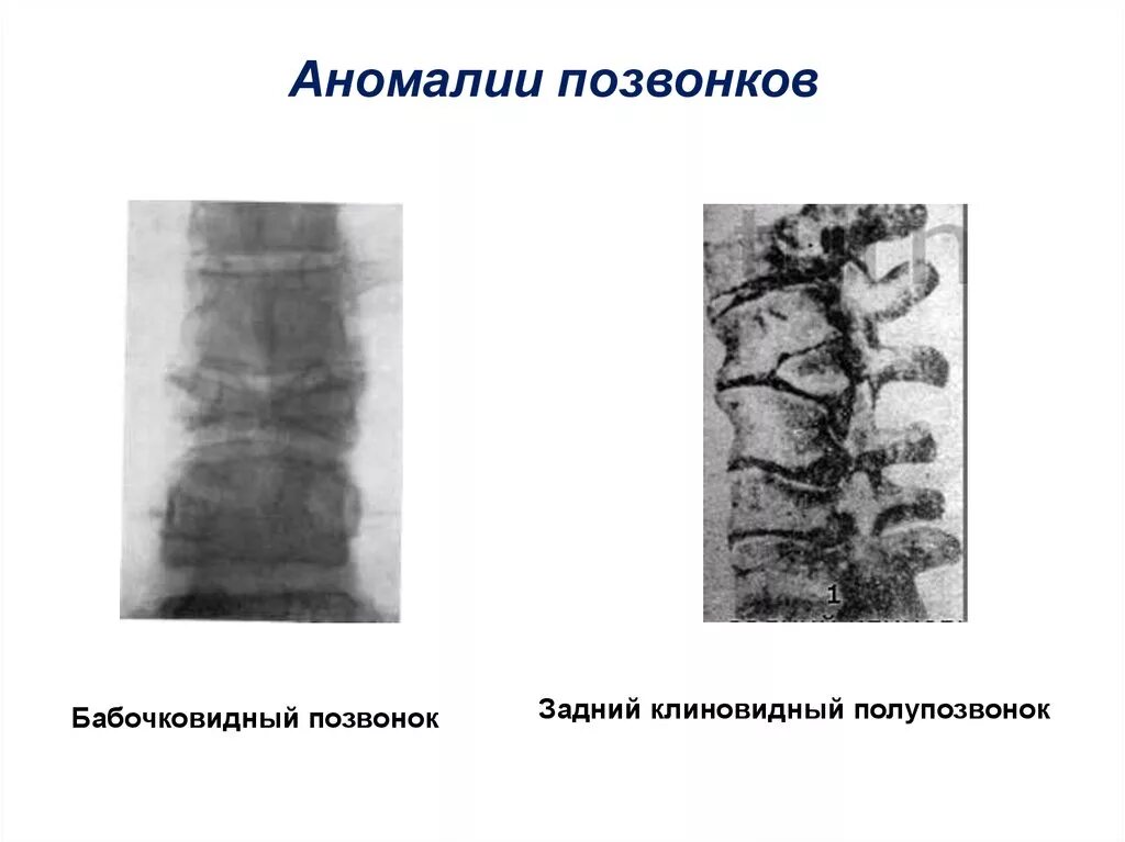 Аномалии тела позвонка. Аномалии развития позвонков полупозвонок. Аномалии развития тел позвонков грудного отдела. Бабочковидные позвонки.