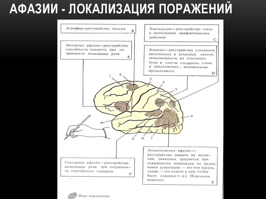 Локальные поражения мозга это. Локализации поражения головного мозга при афазии. Очаг поражения при моторной афазии. Поражение мозга при афазии. Афазии схема мозга.