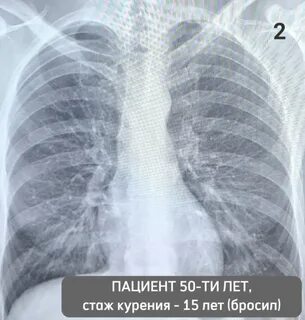 Флюорография видно ли курящего электронную