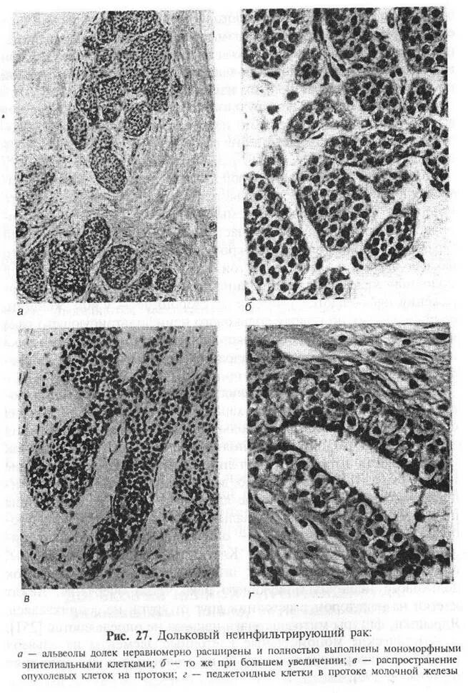 Инфильтрированная опухоль. Инвазивная карцинома молочной железы гистология. Внутрипротоковая карцинома молочной железы микропрепарат. Инфильтрирующая протоковая карцинома g2. Протоковая карцинома молочной железы патанатомия.