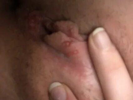 Slideshow can you get genital herpes from sucking dick.