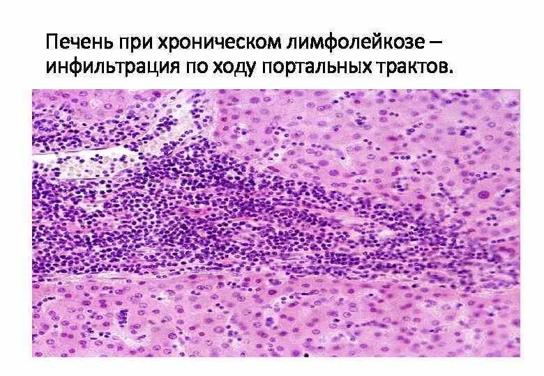 Инфильтрация в гистологии