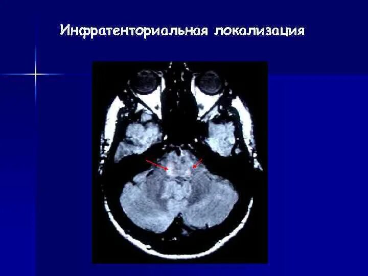 Аксональное демиелинизирующее поражение нерва. Инфратенториальные очаги. Инфратенториальные очаги головного мозга. Инфратенториальные структуры. Инфратенториальная локализация мрт.