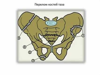 Бугор седалищной кости