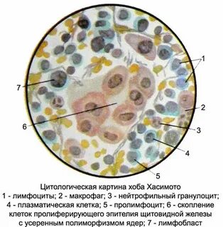 Макрофаги в щитовидной железе