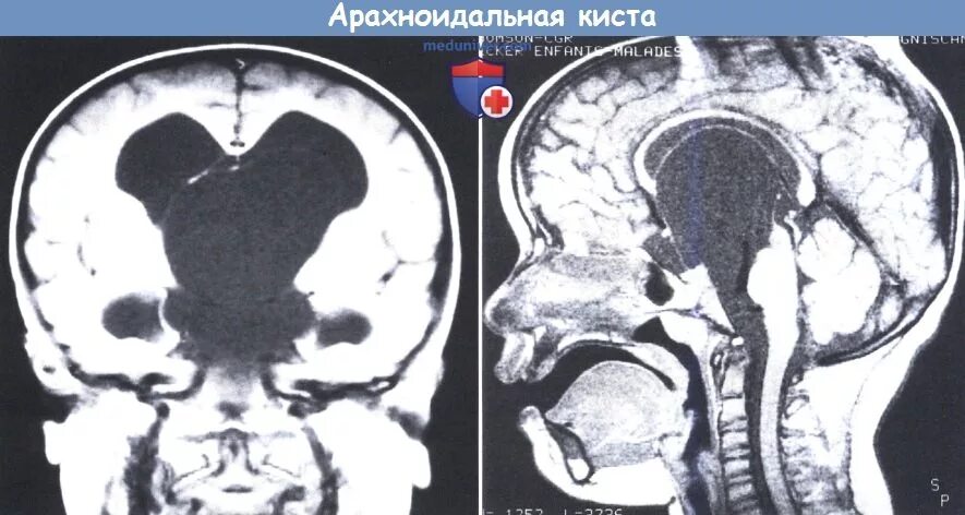 Ретроцеребеллярная арахноидальная киста мрт. Арахноидальная киста 4 желудочка. Супраселлярная арахноидальная киста мрт. Ретроцеребеллярная арахноидальная киста кт.