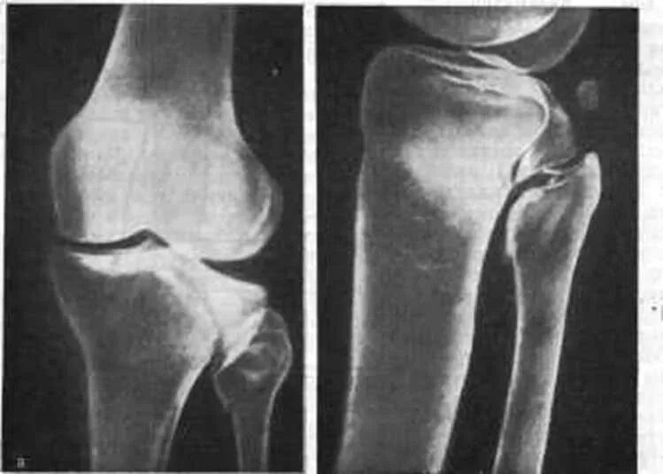 Повреждения мыщелка бедренной кости. Перелом головки малоберцовой кости рентген. Импрессионный перелом головки малоберцовой кости. Перелом большеберцовой кости. Перелом медиального мыщелка.