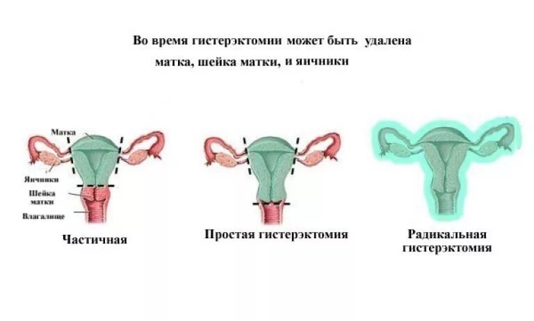 Сколько живут после удаления матки