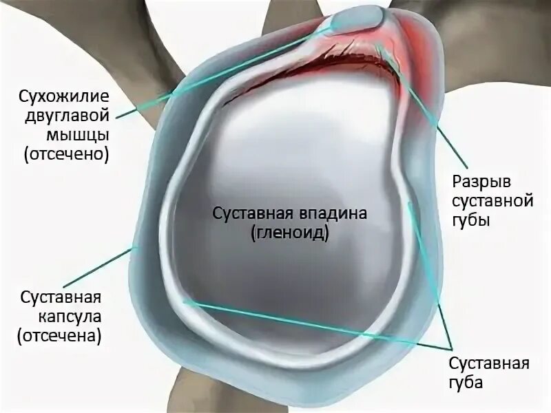 Плечевая губа суставная разрыв. Суставная губа гленоида плечевого сустава. Губа гленоида плечевого сустава анатомия. Повреждение хрящевой губы плечевого сустава. Суставная фиброзно-хрящевая губа гленоида плечевого сустава.