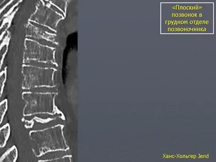 Переломы и вывихи позвоночника