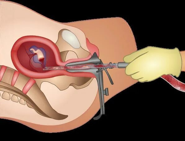 Выскабливание узи. Вакуум-аспирация эндометрия. Вакуум-аспирация полости матки. Вакуумная аспирация полости матки. Вакуум аспирация замершей беременности.