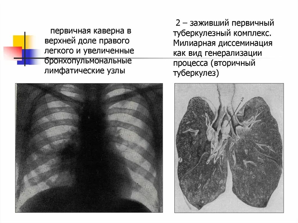 Сколько заживает легкое