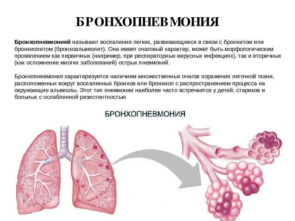 Бронхиальная пневмония. Очаговая бронхиальная пневмония. Крупозная пневмония и бронхопневмония. Гипостатическая бронхопневмония. Острое поражение легких