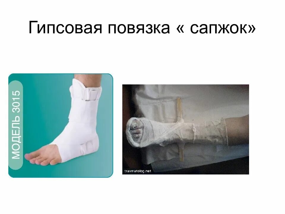 Перелом лодыжек гипсовая иммобилизация. Функциональная гипсовая повязка. Бинтовать голеностоп эластичным бинтом. Техника наложения гипсовой повязки при переломе лодыжки. Лонгетно циркулярная повязка.