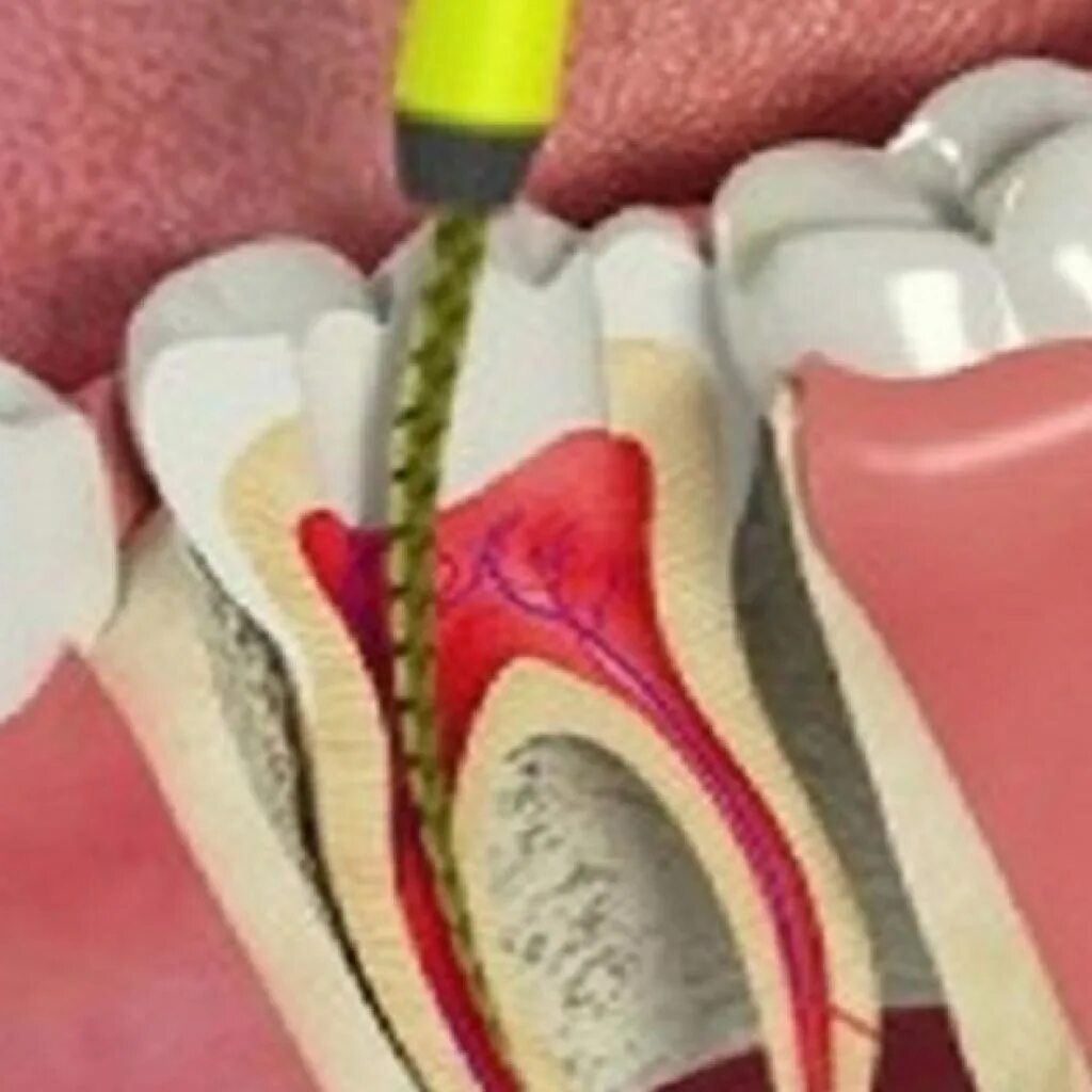 Зубной канал это в стоматологии. Пульпит терапевтическая стоматология. Лазерная терапия корневых каналов.