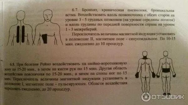 Алмаг 1 при бронхите. Схема постановки вакуумных банок. Алмаг детям при кашле. Алмаг 1 при кашле. На сколько ставят банки на спину взрослым