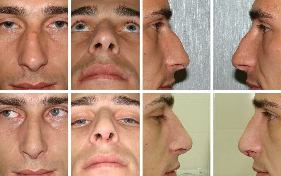Ринопластика искривление носовой. Ринопластика кривой нос. Отек после ринопластики. Ринопластика носа. Закрытая септопластика.