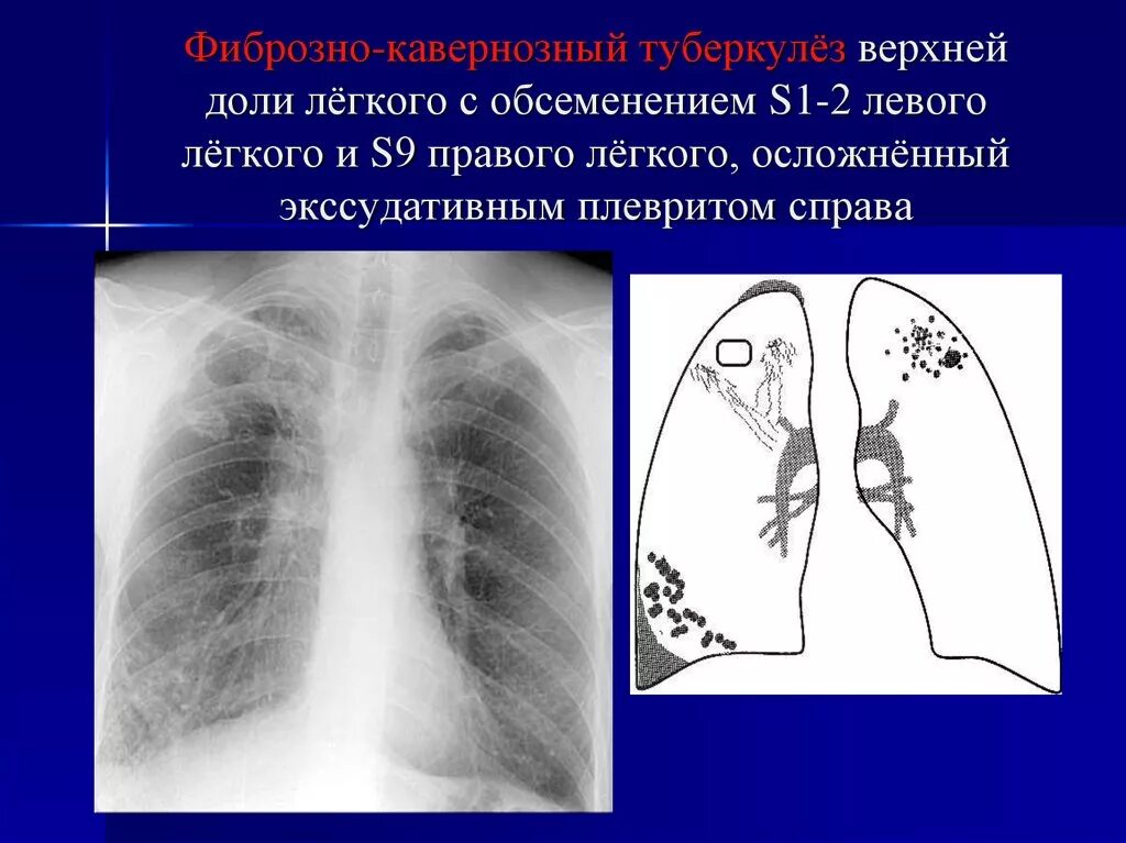 Как лечить фиброзные изменения